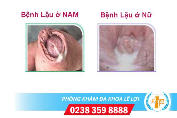Tiểu ra dịch có ảnh hưởng gì không?