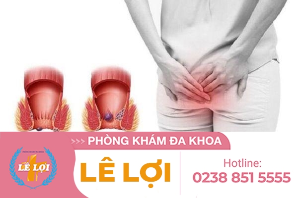 Chữa lòi dom sau sinh như thế nào?