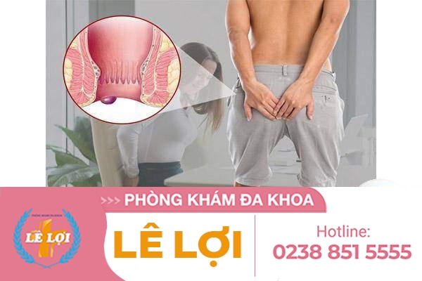 Trĩ ngoại các cấp độ nặng nhẹ