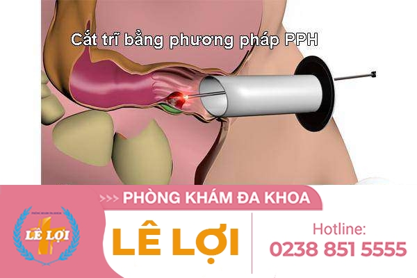 Cắt trĩ bằng phương pháp PPH là gì?