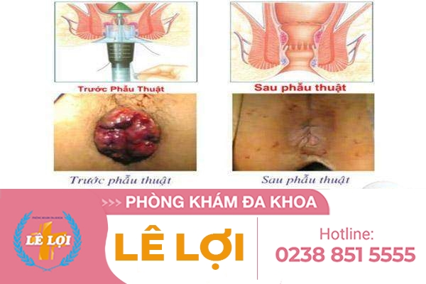 Phương pháp cắt trĩ Longo có tốt không?