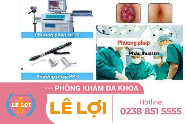 Những cách làm xẹp búi trĩ an toàn hiệu quả cao