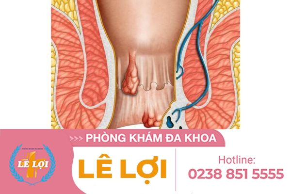 Lòi dom sau sinh dấu hiệu và cách điều trị