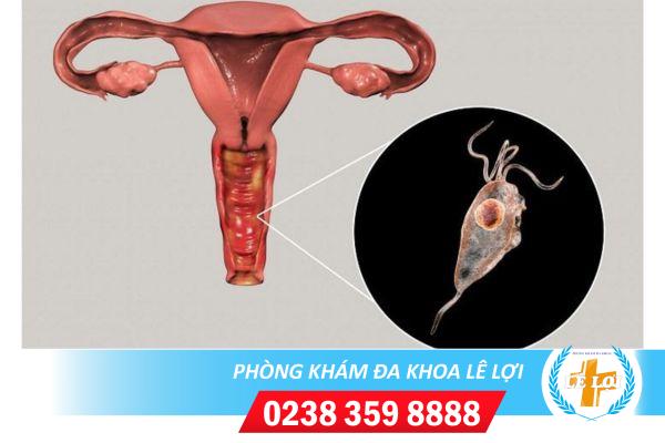Nấm trichomonas và cách điều trị