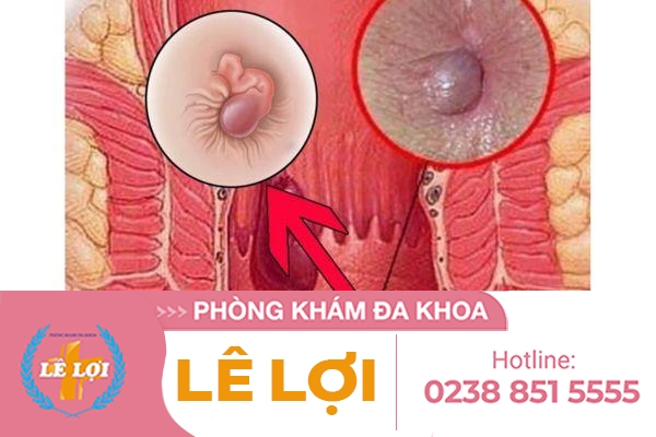 Sa Búi Trĩ, Triệu Chứng Và Phương Pháp Hỗ Trợ Điều Trị Hiệu Quả