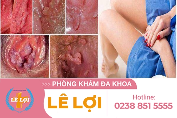 Chữa sùi mào gà ở âm đạo thế nào?