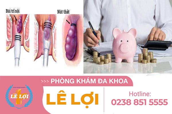 Giá 1 ca thắt búi trĩ bao nhiêu tiền?