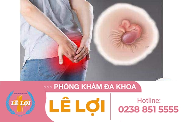 Cách nhận biết các cấp độ trĩ hỗn hợp