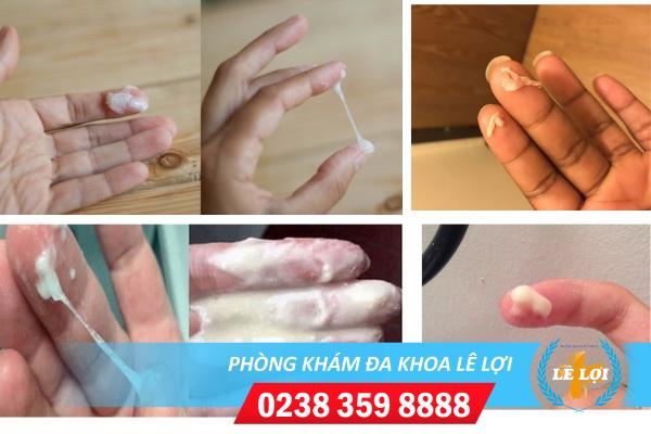 Nguyên nhân dịch âm đạo đặc sệt, dịch âm đạo đặc dính