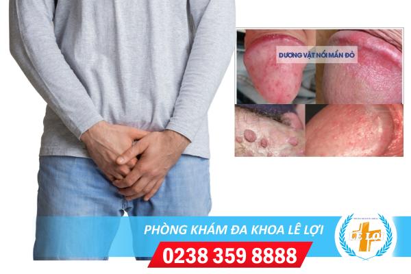Dương vật nổi mẩn đỏ ngứa là bệnh gì?