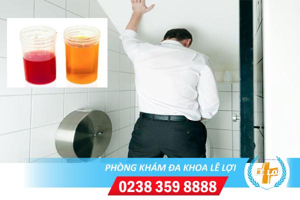 Nước tiểu màu đỏ là bị bệnh gì?
