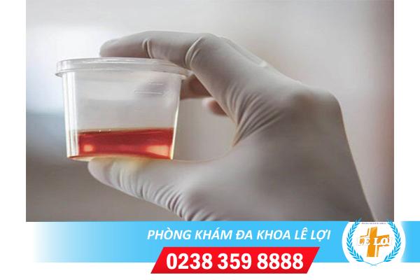 Chữa tiểu ra máu thế nào hiệu quả?