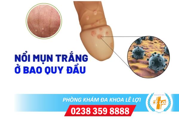 Nguyên nhân nổi mụn trắng ở bao quy đầu