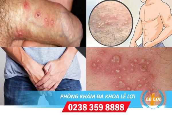 Mụn vùng kín nam cảnh báo bệnh gì?