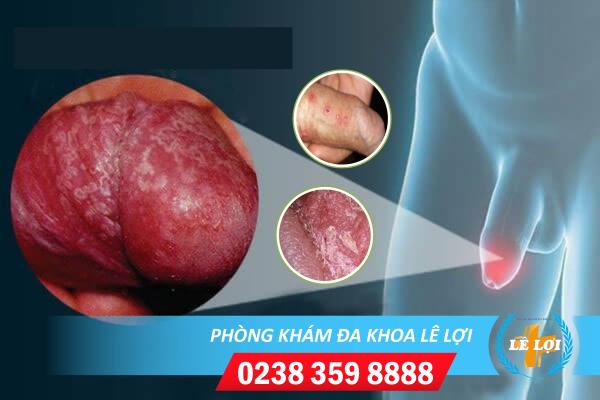 Dấu hiệu nhiễm nấm vùng kín nam giới