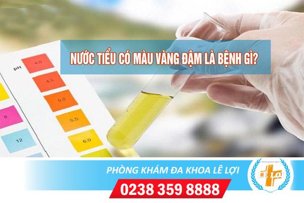 Nước tiểu màu vàng đậm là bị bệnh gì?