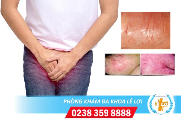 Nứt da bao quy đầu phải làm sao?