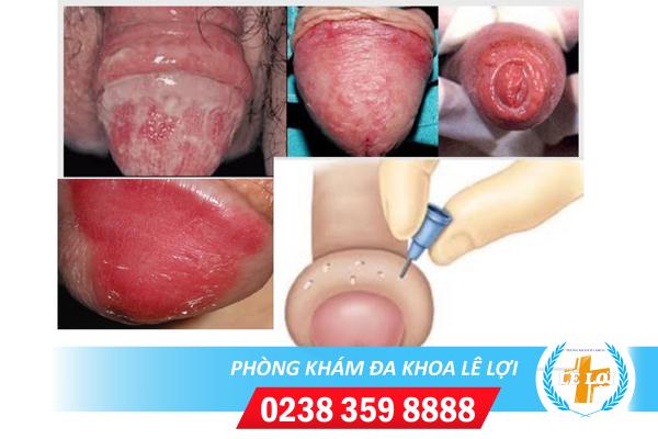 Bao quy đầu bị sưng mọng nước phải làm sao?