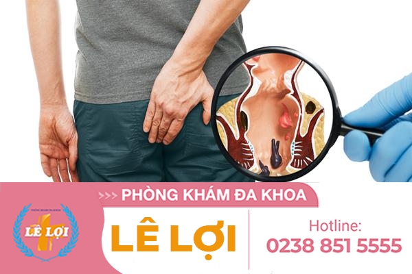 Bị trĩ phải làm sao?