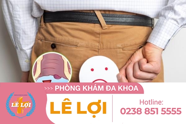 Cách chữa trĩ ngoại hiệu quả và an toàn