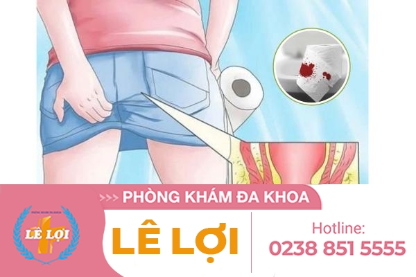 Các Triệu Chứng Bệnh Trĩ Hay Gặp Là Gì?