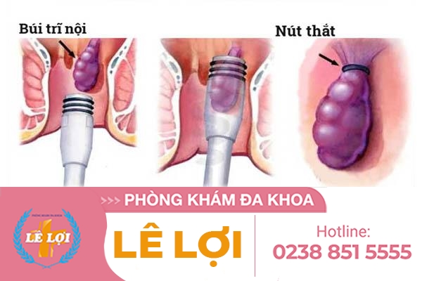 Thắt búi trĩ là gì có hiệu quả không?