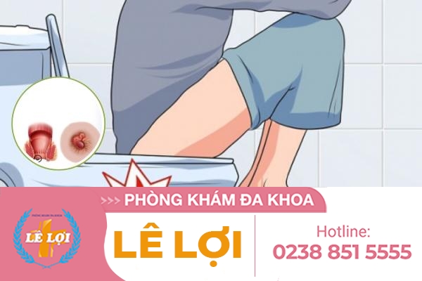 Địa chỉ chữa trĩ nội ở đâu tốt nhất Nghệ An?