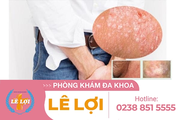 Nấm tinh hoàn nguyên nhân dấu hiệu và cách khắc phục