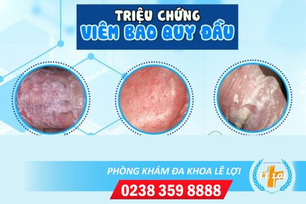 viem-bao-quy-dau-trieu-chung