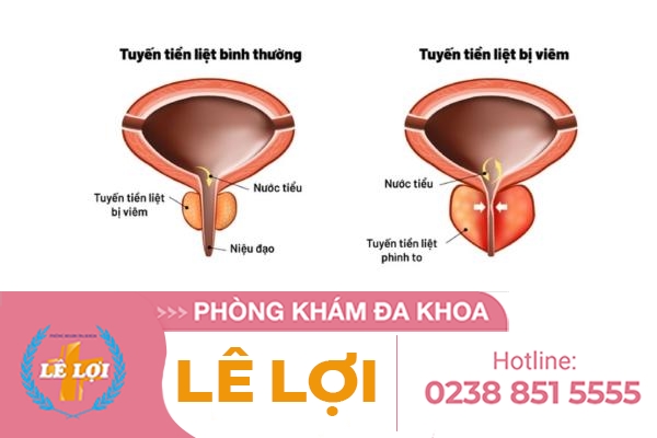 viem-tuyen-tien-liet-nam