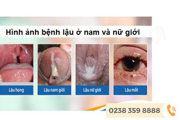 benh-lau-1